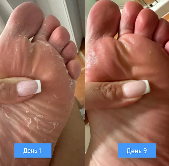 New aura антигрибковий крем